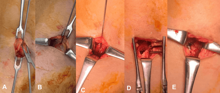 Five operative photographs, A to E, of a posteromedial knee exposure for PCL avulsion screw fixation