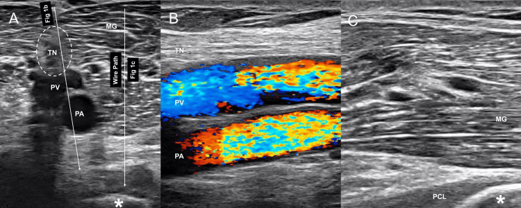 Three ultrasound panels, A to C, labelling the tibial nerve, PV, PA, medial gastrocnemius, PCL and a wire path