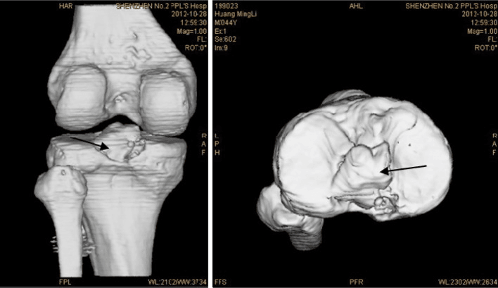 Two postoperative three-dimensional CT views with arrows on the reduced PCL avulsion fragment
