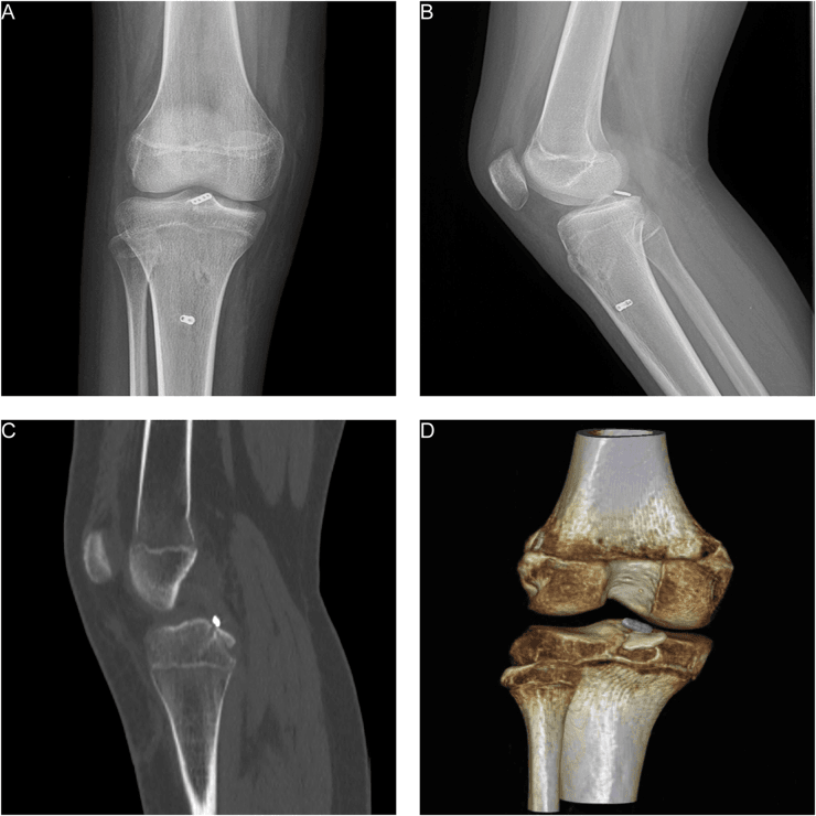 Postoperative AP and lateral knee radiographs, a CT slice and a three-dimensional CT after arthroscopic dual fixation of a PCL avulsion