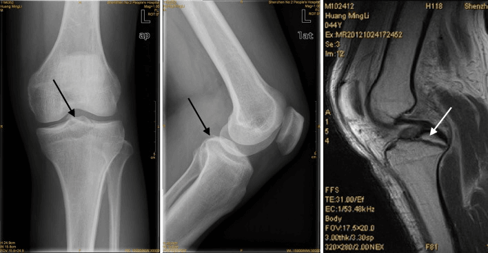 AP and lateral knee radiographs with black arrows and an MRI with a white arrow on a tibial PCL avulsion