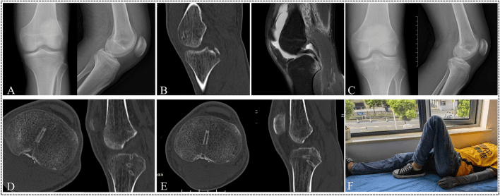 Six-panel montage, A to F, of radiographs, CT, MRI and a patient photograph from a PCL avulsion treated with a suture bridge