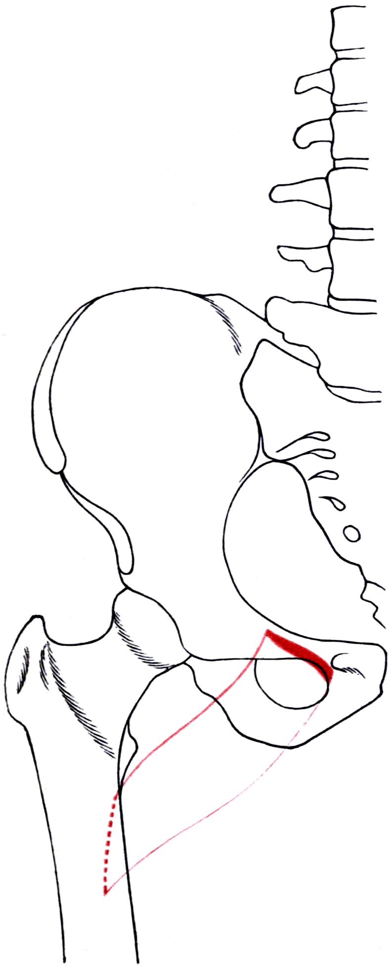 Diagram of the right hip bone and femur outlining pectineus with its bony attachment areas shaded.