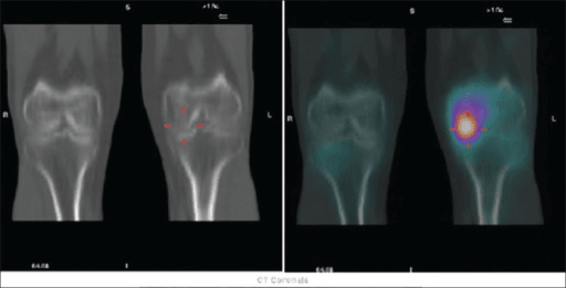 Functional imaging example at the ACL femoral insertion after injury