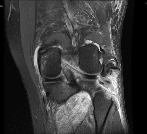 Sagittal MRI example demonstrating ACL tear features