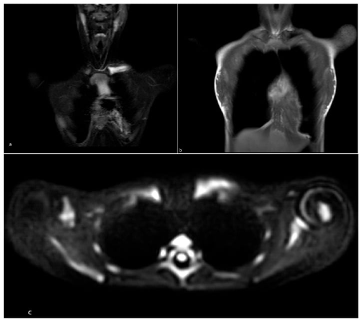 Whole-body MRI sequences showing a medial clavicle lesion in chronic non-bacterial osteomyelitis.