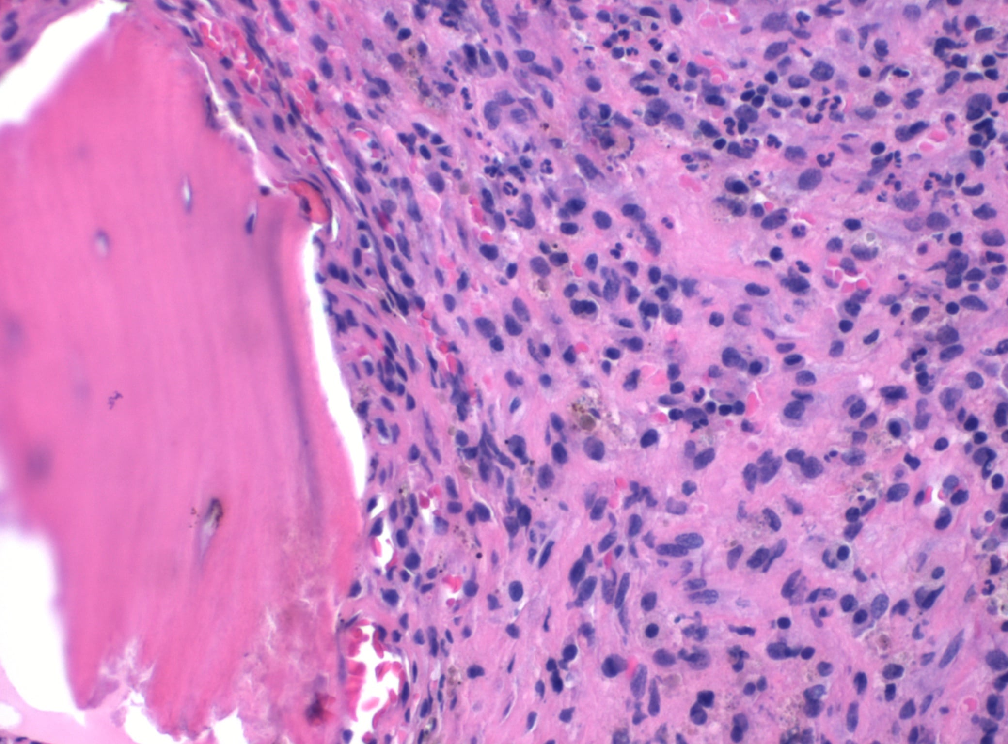 H&E histology of acute osteomyelitis showing a bone trabecula bordered by marrow densely infiltrated with neutrophils.