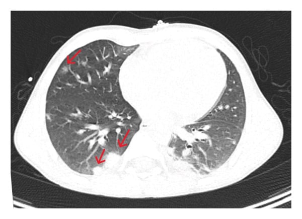 Axial chest CT showing multiple bilateral peripheral consolidations from septic pulmonary emboli.