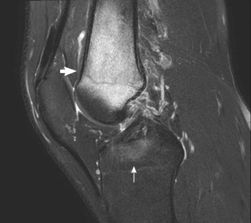 MRI example of marrow signal change in acute paediatric bone infection