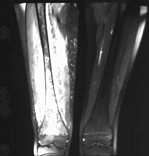 MRI showing acute osteomyelitis with adjacent abscess collection