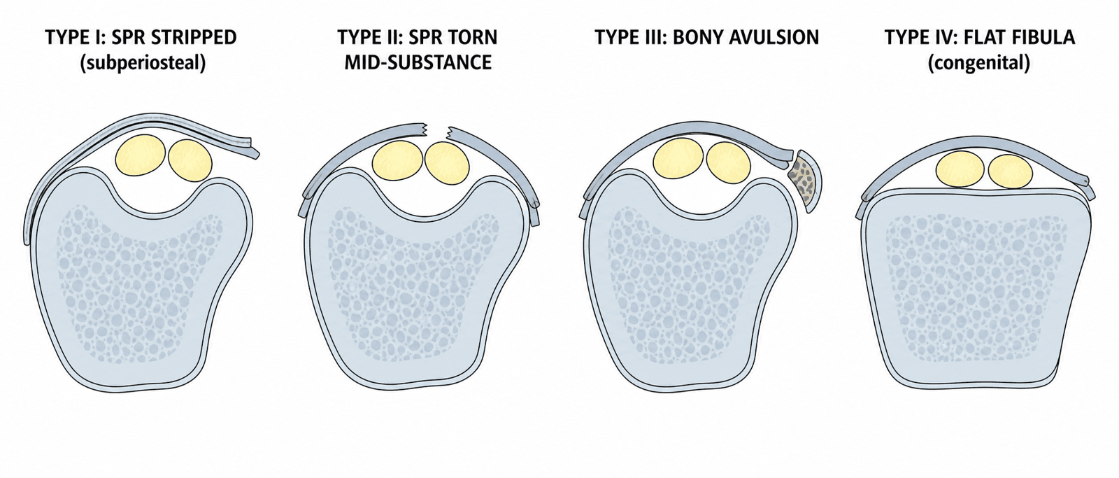 Oden classification of superior peroneal retinaculum (SPR) injury patterns, axial cross-sections of the fibular groove