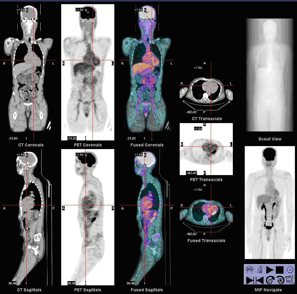 Whole-body FDG PET-CT scanner workstation display showing CT, PET and fused coronal and sagittal images, transaxial slices, scout view and maximum-intensity-projection navigation