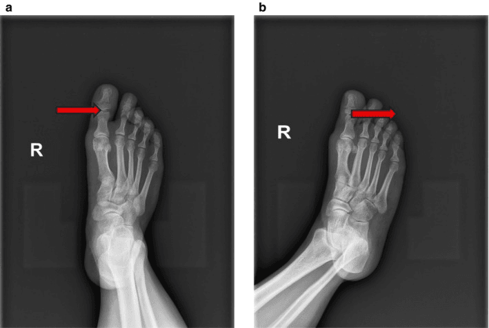 Preoperative radiographs of the right foot, panels a and b, with red arrows at the hallux interphalangeal joint marking a distal phalanx fracture with an interposed interphalangeal sesamoid