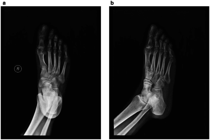 Follow-up radiographs of the right foot, panels a and b, showing a united hallux distal phalanx fracture after K-wire removal