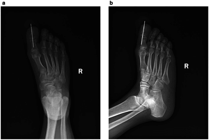 Postoperative radiographs of the right foot, panels a and b, with a single longitudinal K-wire in the hallux and fracture malalignment from interphalangeal sesamoid impingement