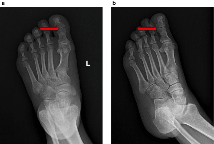 Radiographs of the contralateral left foot, panels a and b, with red arrows at a sesamoid within the hallux interphalangeal joint