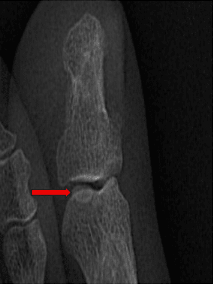 Magnified radiograph of the hallux interphalangeal joint with a red arrow at the interphalangeal sesamoid