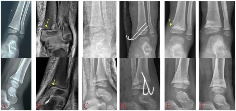 Distal tibial physeal injury shown on radiographs and MRI with persistent physeal widening and periosteal entrapment