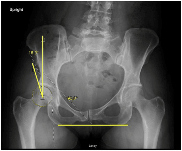 Pincer-Type Femoroacetabular Impingement | OrthoVellum