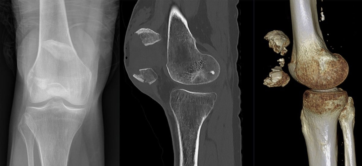 AP knee radiograph, sagittal CT and 3D CT of a displaced transverse patella fracture in an older adult