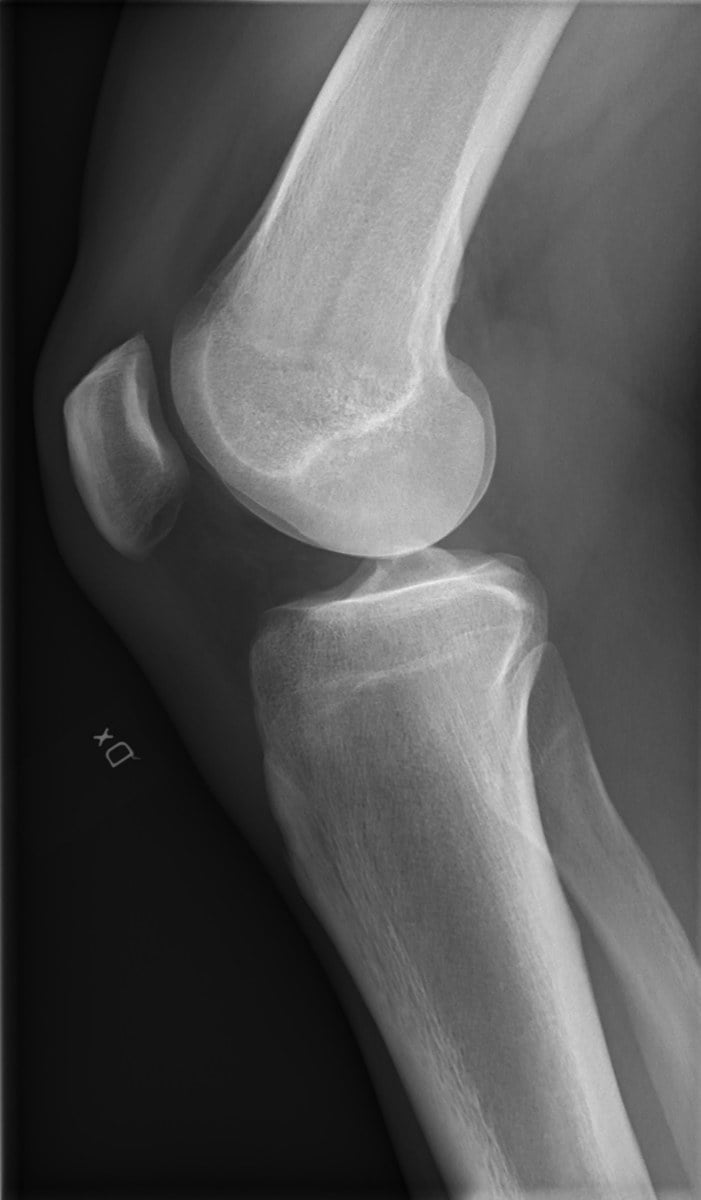 Normal lateral knee radiograph showing intact femur, patella, tibia and fibula with no fracture