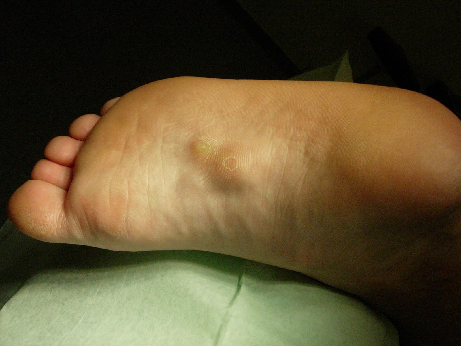 Sole of a foot showing a firm nodule in the medial plantar arch in plantar fibromatosis (Ledderhose disease).