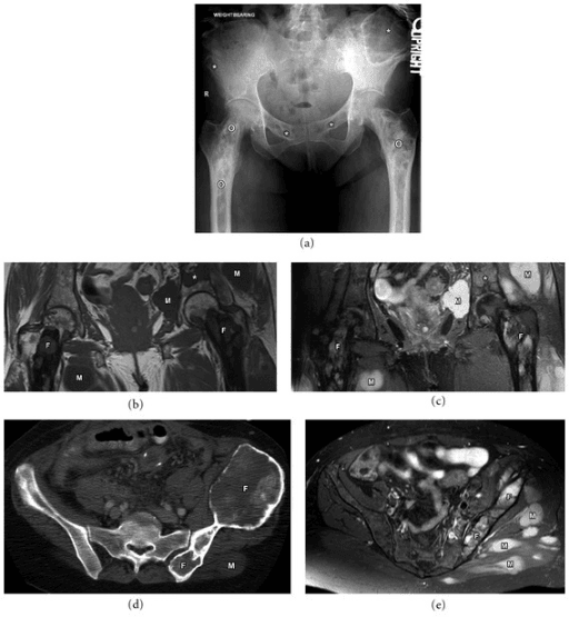 Pelvic radiograph with multiple lucent lesions of ground-glass density, marked with asterisks, and labelled soft tissue myxomas.