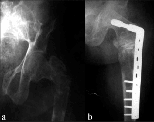 Paired anteroposterior hip radiographs before and after plate and screw fixation with bone graft.