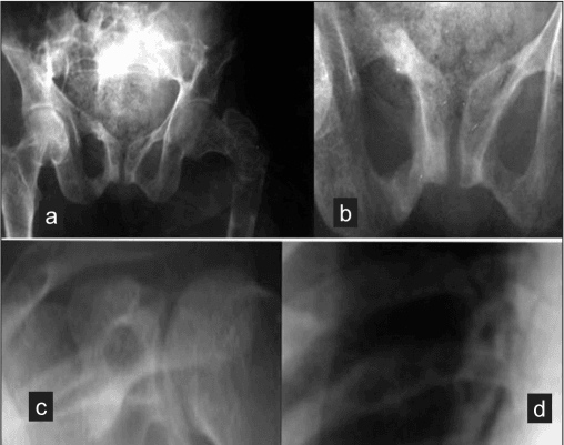 Anteroposterior pelvic radiograph with a proximal femoral lytic lesion and fracture, plus lucent bands in the pubic rami.