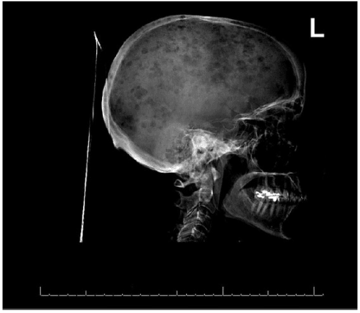 Radiograph of the skull showing several rounded lucent defects in the calvarium.