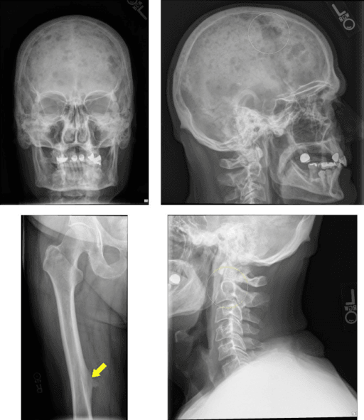 Imaging showing circled lytic lesions in the skull and cervical spine and an arrow marking a lytic lesion in the right femur.