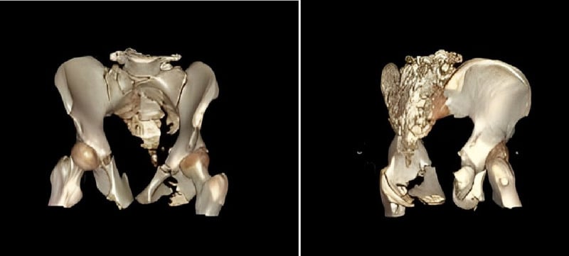 Two three-dimensional CT reconstructions of a comminuted, displaced pelvic-ring fracture viewed from different angles
