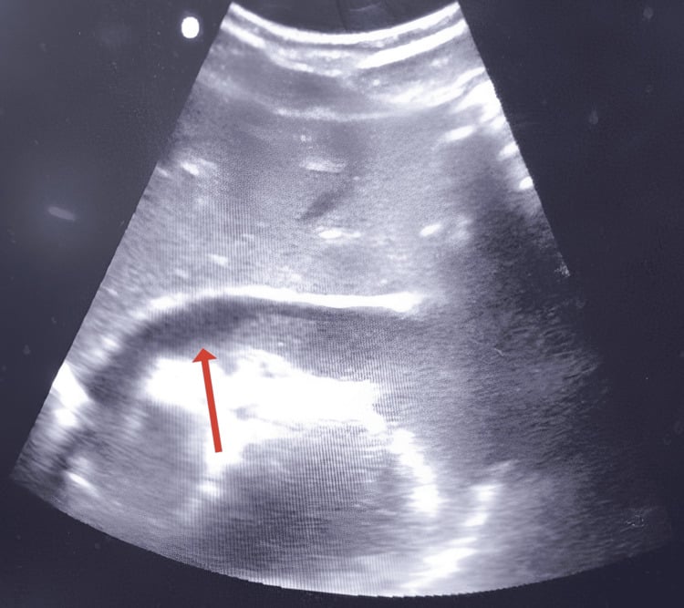 EFAST image with an arrow marking a significant anechoic pericardial effusion