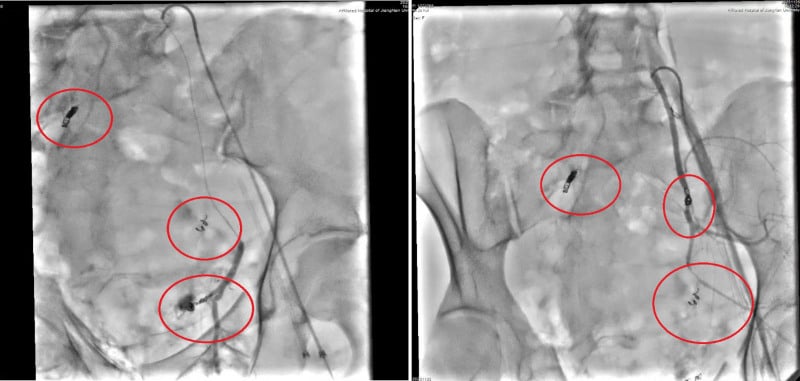 Two pelvic angiograms with red circles marking the sites of selective internal iliac embolisation and a covered iliac stent