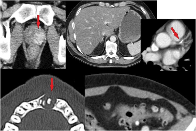 Five axial CT images from a polytrauma whole-body CT, with red arrows on findings in the prostate, a coronary artery and the mandible