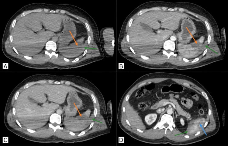 Four axial CT images in different contrast phases showing a splenic laceration and perisplenic haemoperitoneum