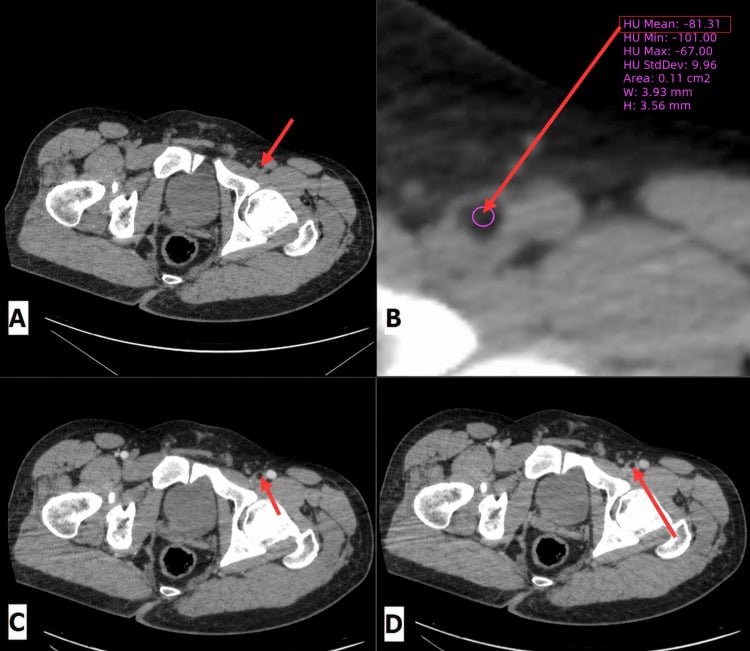Axial CT showing a fat-density focus in the left iliofemoral vein after femoral fracture, with a region-of-interest measurement