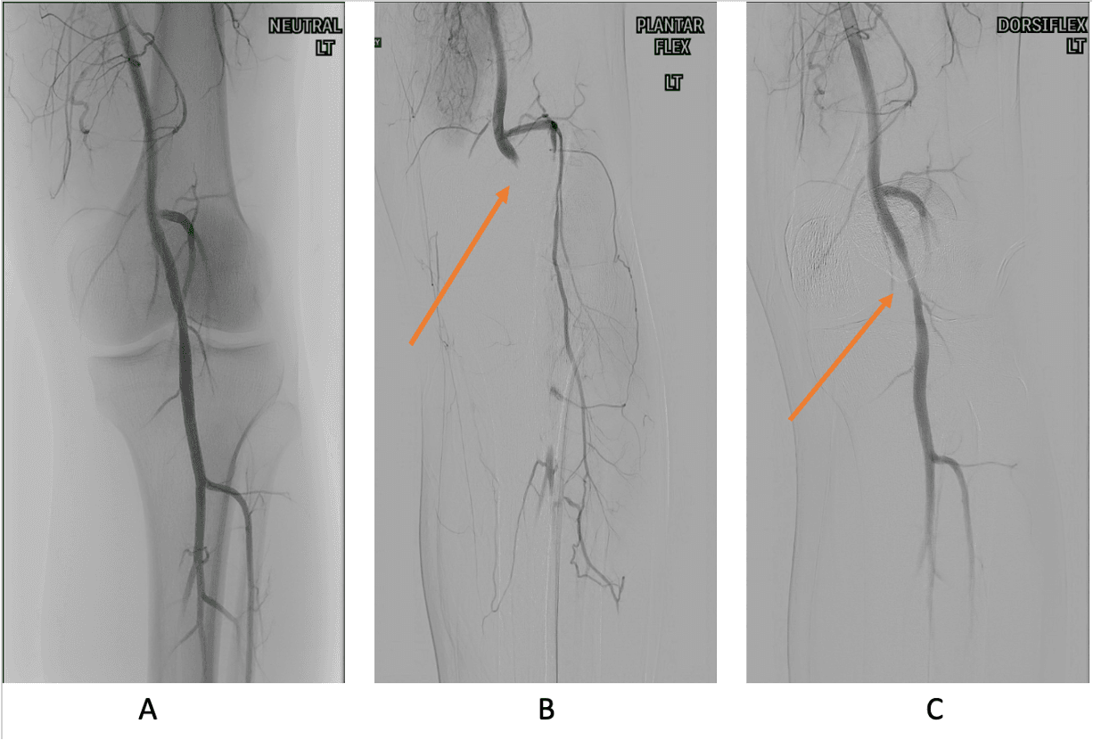 Angiogram showing compression and occlusion of the popliteal artery in popliteal artery entrapment syndrome.