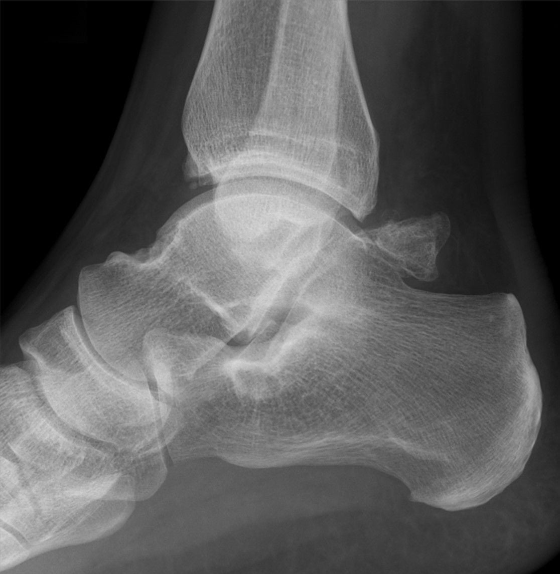 True lateral ankle radiograph showing an unusually large os trigonum as a separate ossicle posterior to the talus.