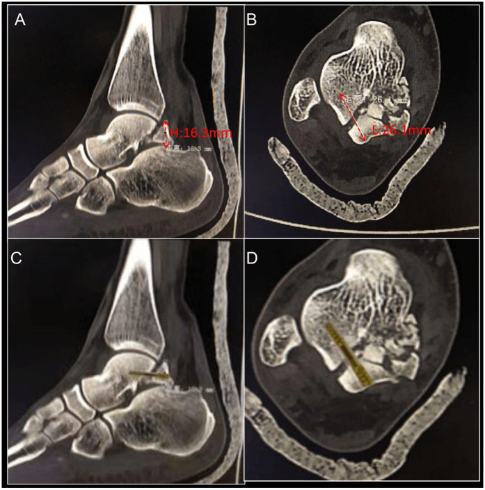 Sagittal and axial CT measuring posterior talus fragment height and planned Herbert screw length, with a virtual screw fitted