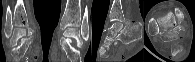 Coronal, sagittal and axial CT of a Cedell fracture nonunion with arrows on the fragment and osteophytes