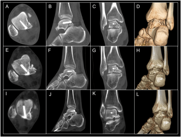 Serial axial, sagittal, coronal and 3D CT showing fixation and healing of combined Cedell and Shepherd fractures, panels A to L