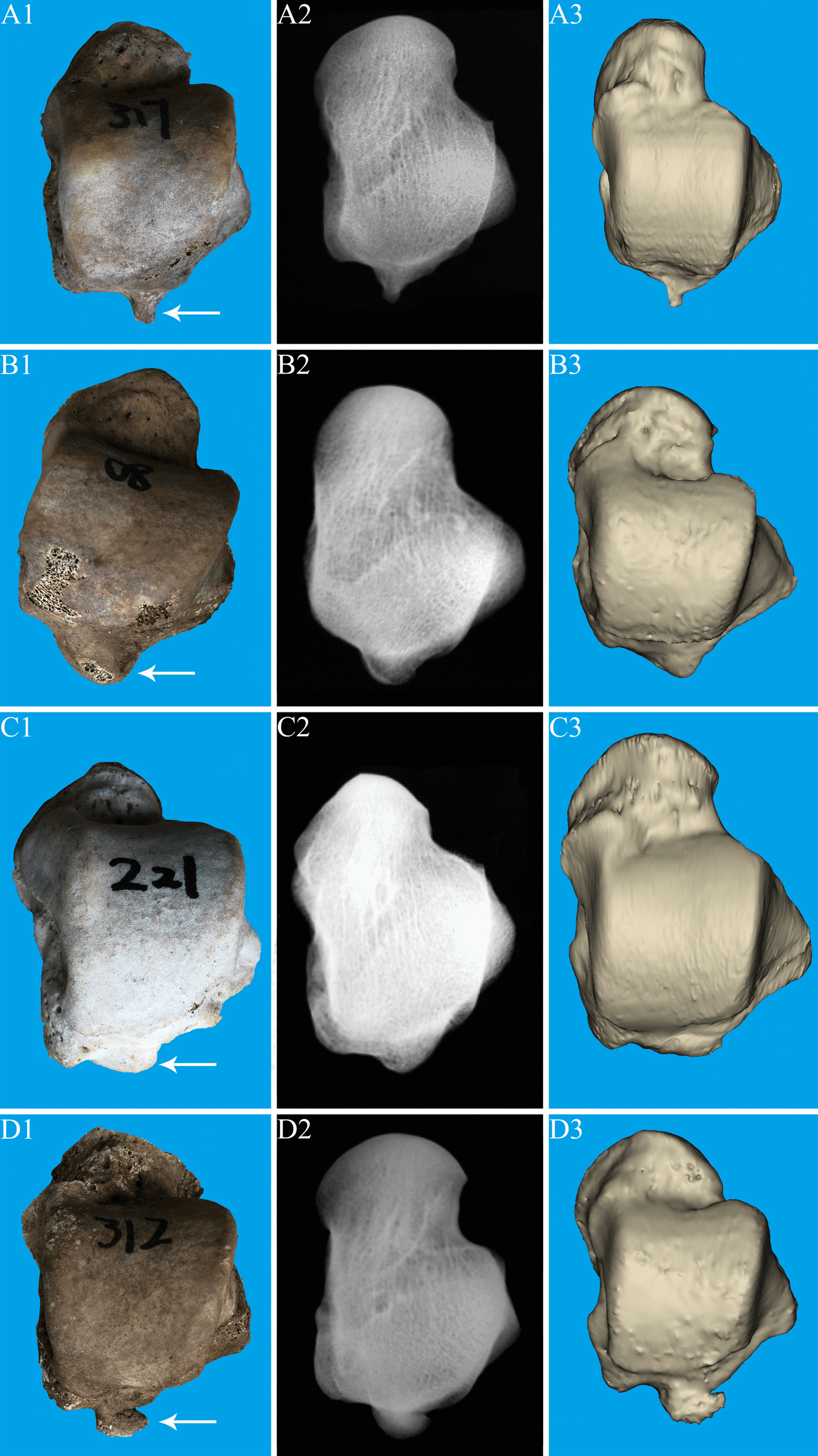 Dry bone, radiograph and 3D CT of four posterior talus process morphologies, rows A to D