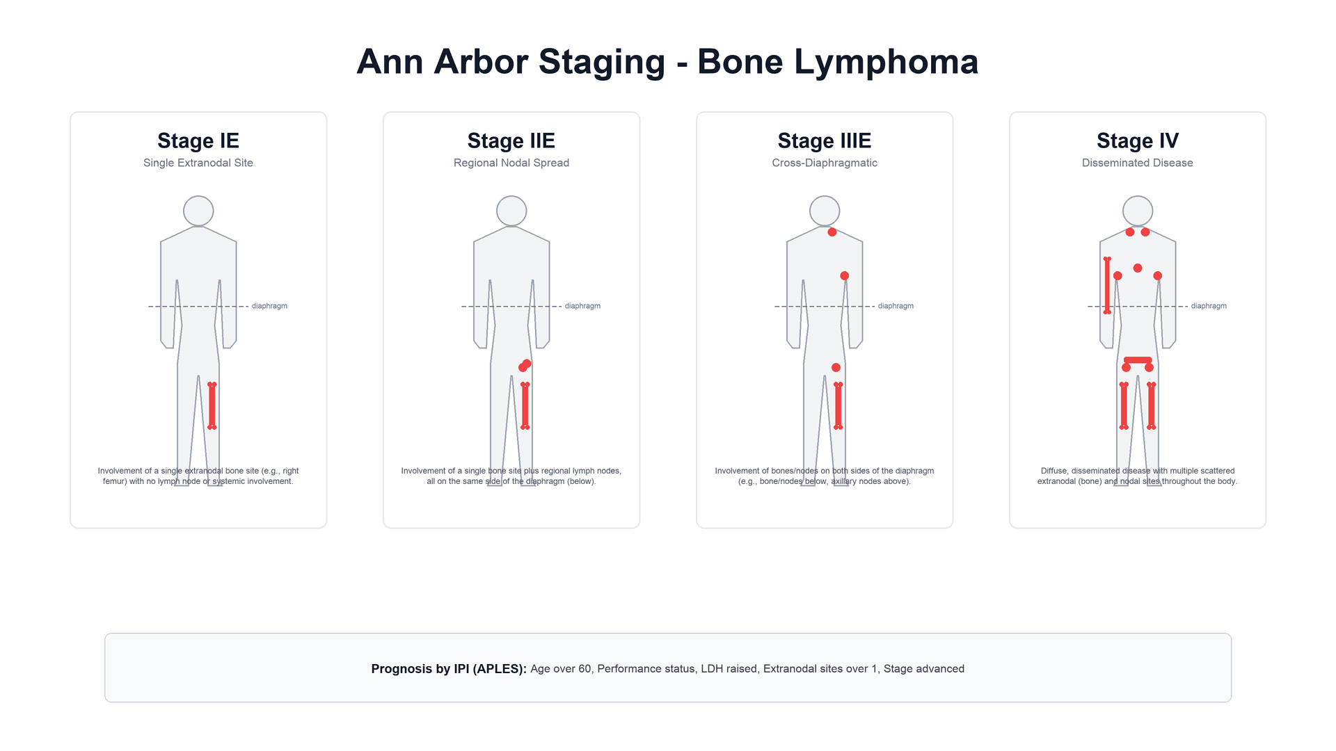Ann Arbor staging of extranodal bone lymphoma across four stages with the IPI prognostic factors