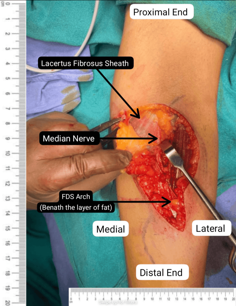 Labelled operative exposure of the lacertus fibrosus sheath, the median nerve and the FDS arch beneath a layer of fat