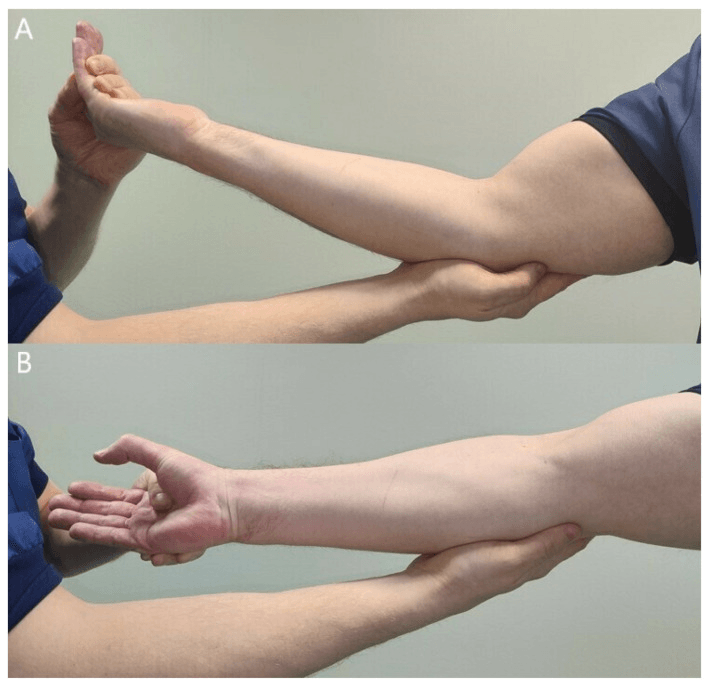 Resisted elbow flexion (A) and resisted forearm pronation from full supination (B) for proximal median compression