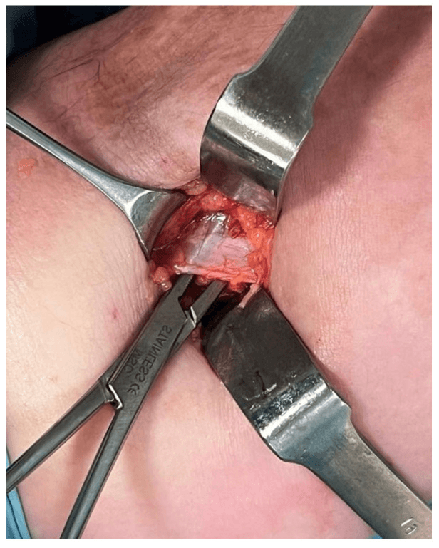 Intraoperative view of the lacertus fibrosus through a small incision with a clamp at the fibrous band