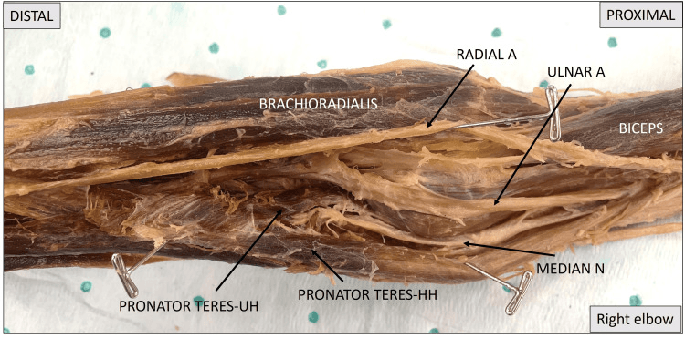 Cadaveric dissection of a right elbow with the median nerve passing between the labelled humeral and ulnar heads of pronator teres