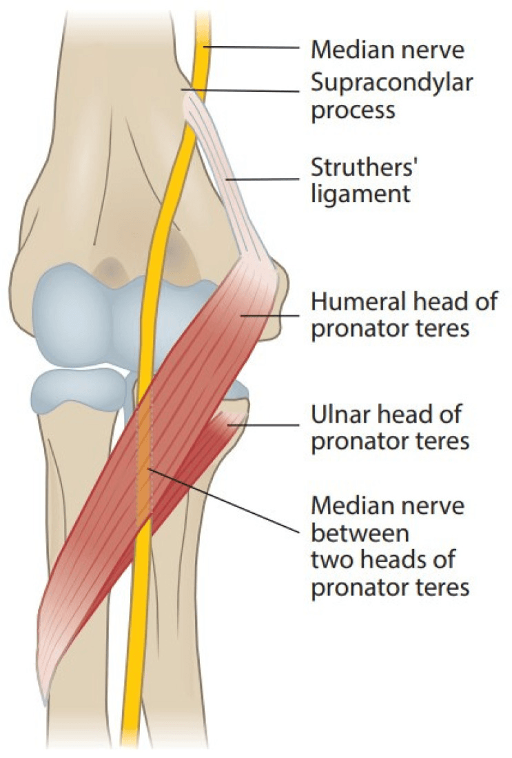 Diagram of the median nerve at the elbow with a supracondylar process, Struthers ligament and the nerve passing between the humeral and ulnar heads of pronator teres