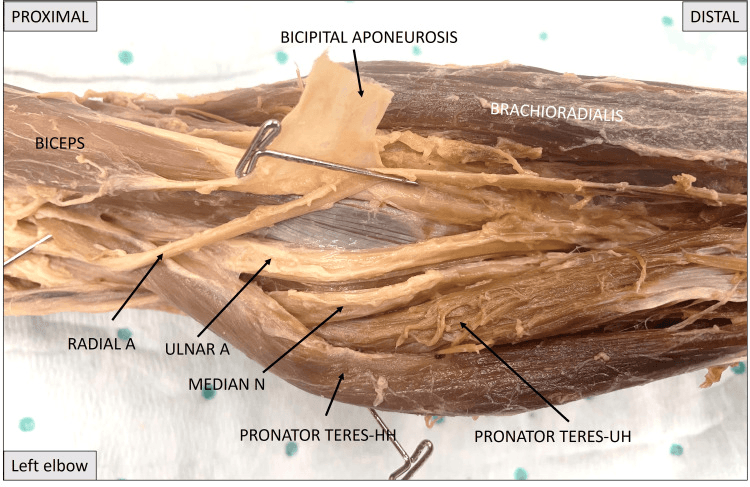 Cadaveric dissection of a left elbow with the bicipital aponeurosis lifted, showing a variant course of the median nerve medial to both heads of pronator teres